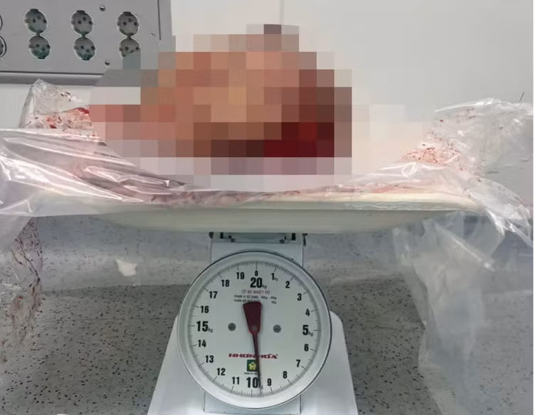 Khối u ở 1 bên vú của bệnh nhân được các bác sĩ BVĐK Đồng Nai phẫu thuật cắt bỏ. Ảnh: Báo Đồng Nai