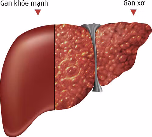 Bởi vậy, nếu như chức năng gan suy giảm, sức khỏe của chúng ta sẽ bị ảnh hưởng nghiêm trọng. Thậm chí, tuổi thọ cũng bị rút ngắn nếu như cơ thể không ổn định. Khi chúng ta không theo đuổi lối sống lành mạnh, gan dễ mắc các bệnh lý như viêm gan, xơ gan, thậm chí là ung thư. Bởi vậy, nếu như chức năng gan suy giảm, sức khỏe của chúng ta sẽ bị ảnh hưởng nghiêm trọng. Thậm chí, tuổi thọ cũng bị rút ngắn nếu như cơ thể không ổn định. Khi chúng ta không theo đuổi lối sống lành mạnh, gan dễ mắc các bệnh lý như viêm gan, xơ gan, thậm chí là ung thư.