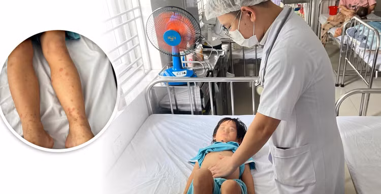 Cẩn trọng với bệnh viêm mao mạch dị ứng ở trẻ em. Ảnh BVCC Cẩn trọng với bệnh viêm mao mạch dị ứng ở trẻ em. Ảnh BVCC