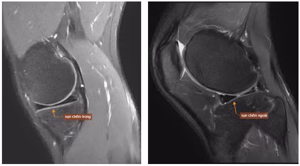 Hình ảnh MRI khớp gối phải của bệnh nhân T.M.H cho thấy dấu hiệu rách quai xô. Ảnh BVCC