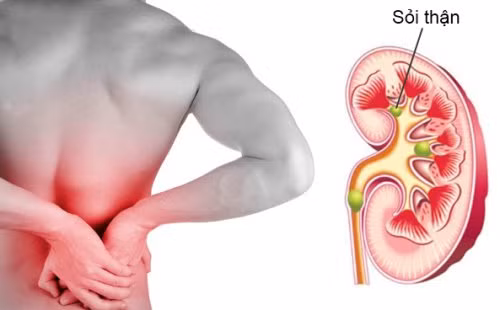 Thói quen xấu thường ngày khiến thận chứa cả ‘túi sỏi'. Ảnh Vinmec Thói quen xấu thường ngày khiến thận chứa cả ‘túi sỏi'. Ảnh Vinmec