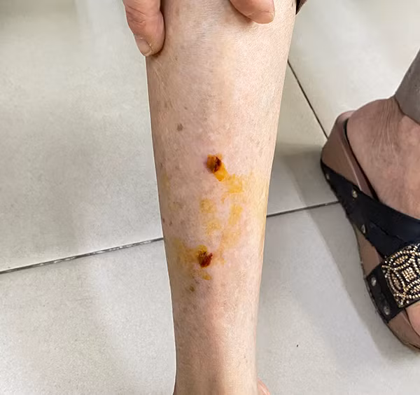 Vết thương ở chân của bệnh nhân do chó cắn. Ảnh CDC Đồng Nai Vết thương ở chân của bệnh nhân do chó cắn. Ảnh CDC Đồng Nai