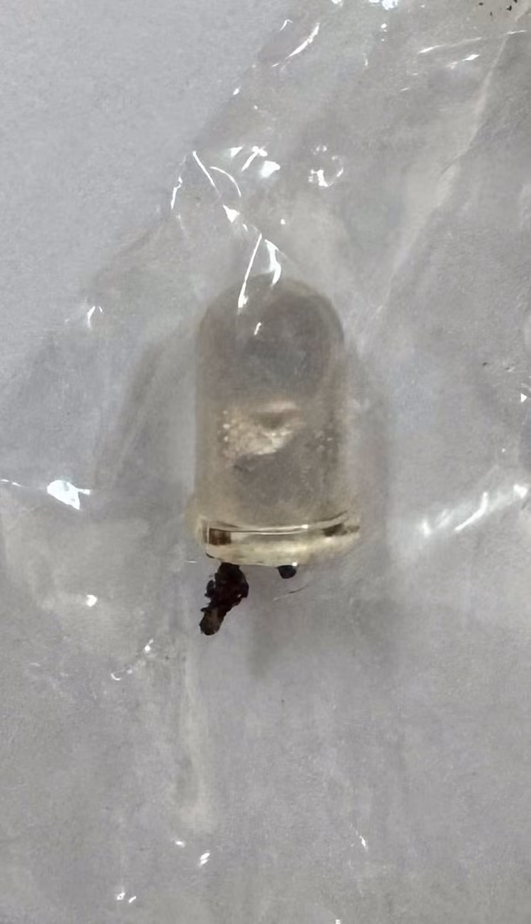 Chiếc bóng đèn led được gắp ra khỏi phế quản bệnh nhi. Ảnh: BVCC Chiếc bóng đèn led được gắp ra khỏi phế quản bệnh nhi. Ảnh: BVCC