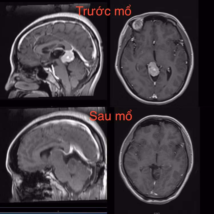 Hình ảnh khối u trước mổ (hàng trên) và sau mổ (hàng dưới) cho thấy khối u đã được loại bỏ hoàn toàn. Ảnh BVHNVĐ