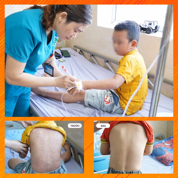 Bệnh nhi được điều trị tại viện. Ảnh BVCC Bệnh nhi được điều trị tại viện. Ảnh BVCC