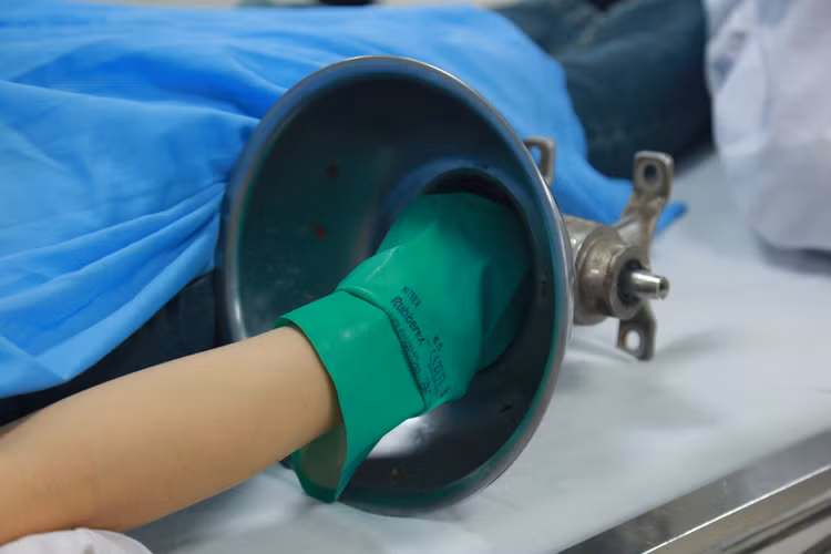 Bệnh nhân đến viện trong tình trạng bàn tay phải kẹt nguyên trong máy xay thịt. Ảnh BVCC Bệnh nhân đến viện trong tình trạng bàn tay phải kẹt nguyên trong máy xay thịt. Ảnh BVCC
