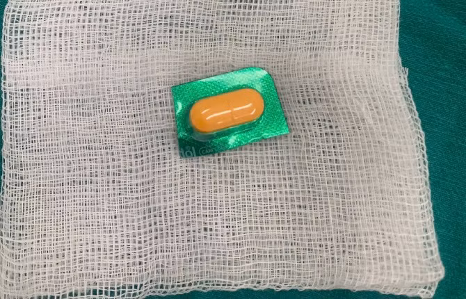 Dị vật lấy ra là viên thuốc còn nguyên vỏ. Ảnh BVCC Dị vật lấy ra là viên thuốc còn nguyên vỏ. Ảnh BVCC