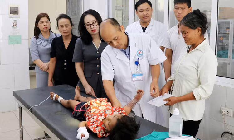 Tay của bệnh nhi bị nhiễm trùng, bỏng độ 3 - Ảnh: Báo Bắc Giang