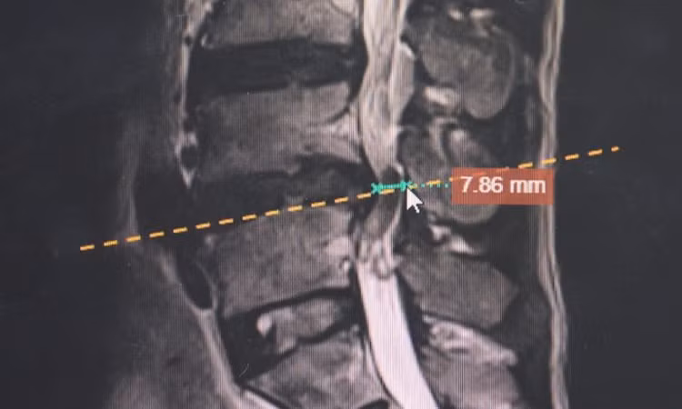 Ảnh chụp MRI thoát vị đĩa đệm của người bệnh. Ảnh BVCC Ảnh chụp MRI thoát vị đĩa đệm của người bệnh. Ảnh BVCC