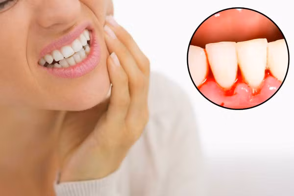 Làm gì để khắc phục chảy máu chân răng?