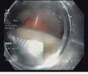 Viên thuốc còn nguyên vỉ nằm trong thực quản bệnh nhân được camera nội soi phát hiện. Ảnh BVCC Viên thuốc còn nguyên vỉ nằm trong thực quản bệnh nhân được camera nội soi phát hiện. Ảnh BVCC