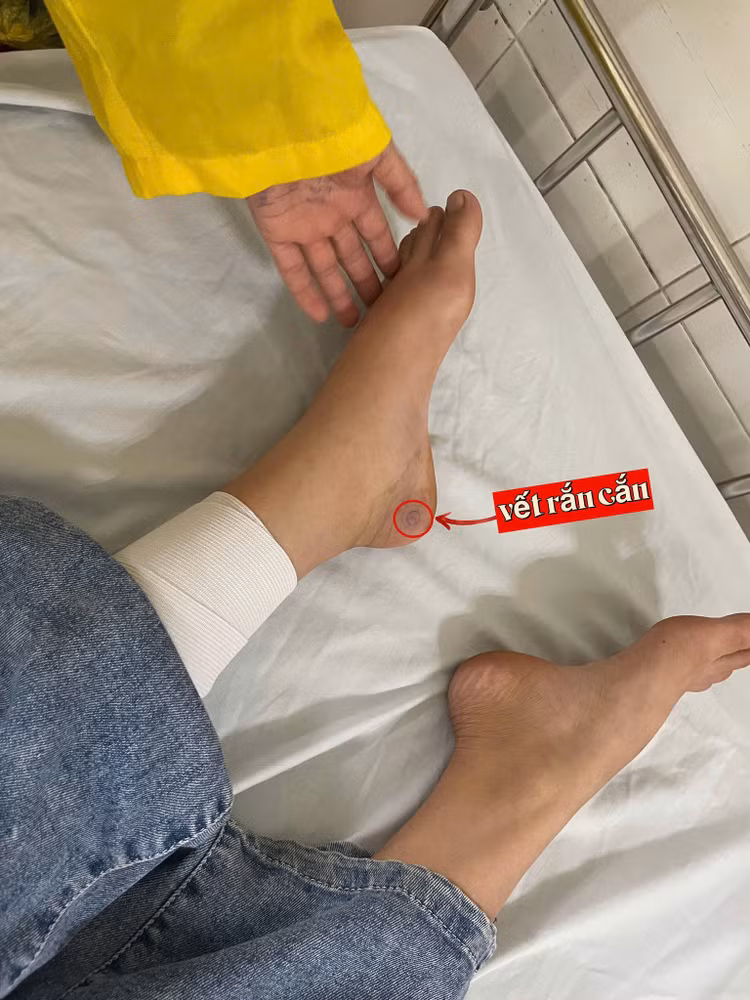 Vết rắn cắn của bệnh nhi. Ảnh BVCC Vết rắn cắn của bệnh nhi. Ảnh BVCC