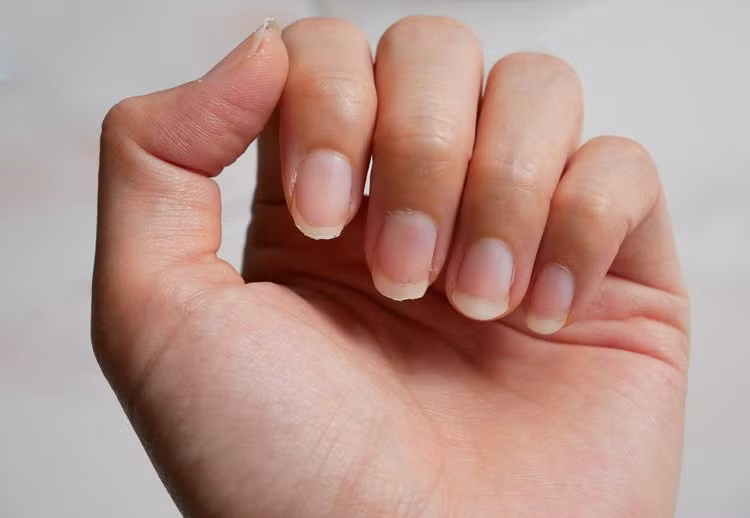 Những dấu hiệu bất thường trên móng tay cảnh báo về tình trạng sức khỏe. Ảnh minh họa