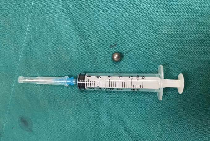 Hình ảnh viên bi được lấy ra ngoài. Ảnh BVCC Hình ảnh viên bi được lấy ra ngoài. Ảnh BVCC