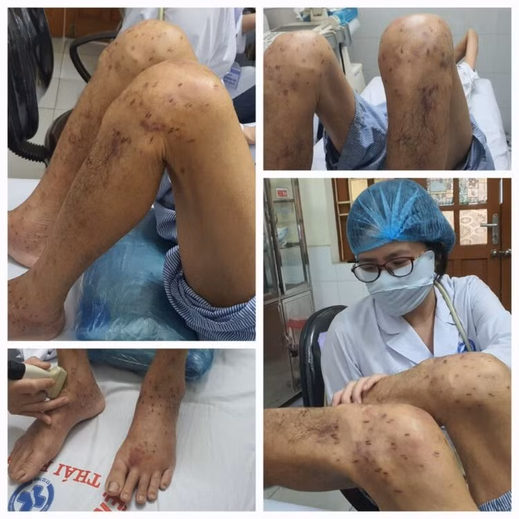 Những tai biến thường gặp do tự điều trị bệnh xương khớp. Ảnh BVCC
