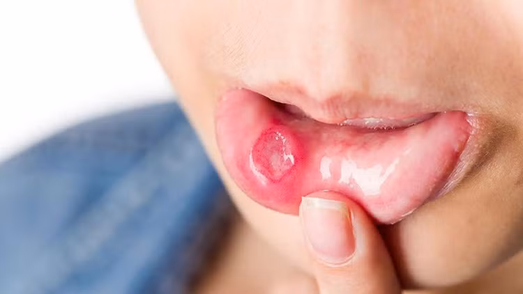 Nhiệt miệng là bệnh khá thường gặp, dù không nguy hiểm song tình trạng đau, sưng ở bên trong miệng gây không ít phiền toái và khó khăn trong việc ăn uống.. Ảnh minh họa
