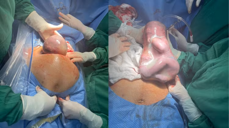 Bé gái chào đời trong "bọc điều" hiếm gặp. Ảnh: CAND Bé gái chào đời trong "bọc điều" hiếm gặp. Ảnh: CAND
