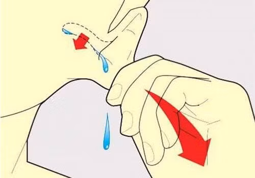 Mẹo xử trí khi bị nước vào tai an toàn, không gây nhiễm trùng. Ảnh minh họa
