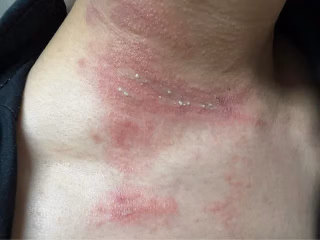 Nam bệnh nhân bị nọc độc của kiến ba khoang lan khắp vùng cổ. Ảnh SK&ĐS Nam bệnh nhân bị nọc độc của kiến ba khoang lan khắp vùng cổ. Ảnh SK&ĐS
