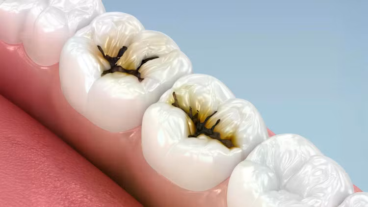 molar-teeth-cavities.jpg