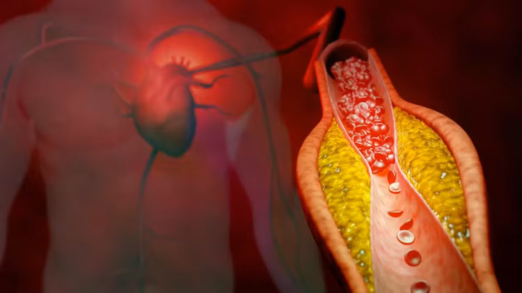 coronary-artery-disease.jpg