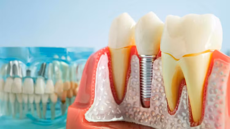 dental-implant.jpg