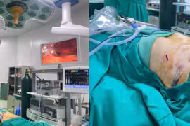 Phát hiện sớm lõm ngực bẩm sinh để tránh biến chứng nguy hiểm