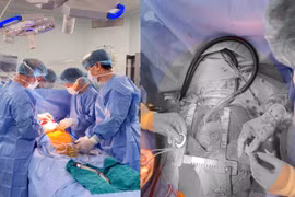 Cấy ghép CorHeart 6 mở ra hy vọng mới cho bệnh nhân suy tim nặng
