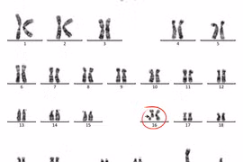 Khám tiền sinh sản, nam thanh niên bất ngờ phát hiện nhiễm sắc thể bất thường