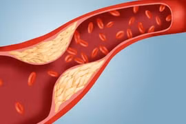 Chế độ ăn giảm cholesterol xấu, phòng ngừa bệnh tim mạch