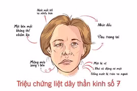 Liệt dây thần kinh số 7: Nhận biết sớm để tránh biến chứng nặng