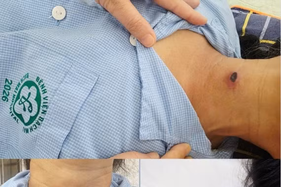 Sốt cao kéo dài, đừng bỏ qua tổn thương nhỏ trên da
