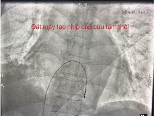 Nhịp tim chỉ 27–35 lần/phút, cụ ông 77 tuổi nguy kịch