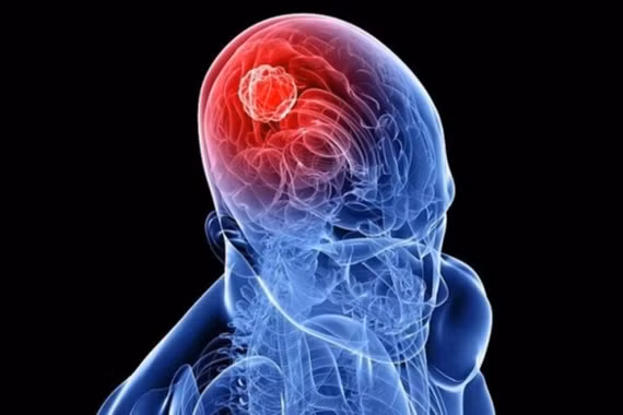 Nhận biết sớm dấu hiệu u não, tránh biến chứng nguy hiểm