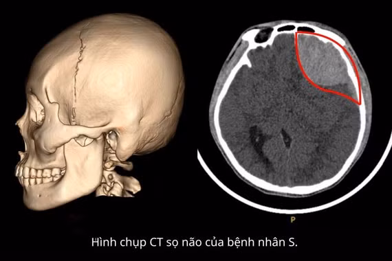 Tỉnh táo sau tai nạn, hai thanh niên nguy kịch vì chấn thương sọ não 
