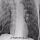COPD khó thở bất thường, cụ ông 71 tuổi suy hô hấp vì tràn khí màng phổi