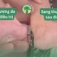 Mẹ mắc giang mai khi mang thai, con nhiễm bệnh dễ viêm não