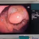 Viêm loét đại trực tràng chảy máu kèm đa polyp ở người đàn ông 49 tuổi