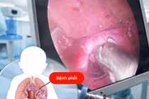 Mổ dị dạng phổi bẩm sinh cho trẻ 10 tháng tuổi phát hiện qua siêu âm tiền sản
