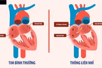Tim bẩm sinh thông liên nhĩ ở người lớn điều trị thế nào?