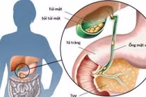 Phẫu thuật lấy gần 300 viên sỏi túi mật cho người phụ nữ 61 tuổi