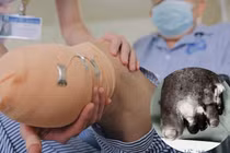 Vết bỏng nhỏ thành 'đại họa', người bệnh đái tháo đường phải cắt chân