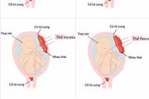 Bảo tồn tử cung cho sản phụ mắc rau cài răng lược đe dọa tính mạng