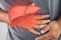 Cách phục hồi nhanh sau nút mạch điều trị ung thư gan