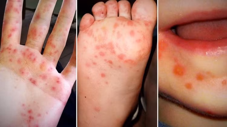 Hà Nội: Ca mắc tay chân miệng tăng nhanh Ha Noi: Ca mac tay chan mieng tang nhanh