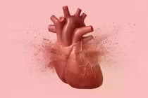 Hệ thống BioTAK giúp phân biệt hội chứng Takotsubo và đau tim chính xác