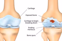 Phát hiện thuốc chống động kinh giúp phục hồi sụn khớp hiệu quả hơn