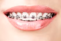Sai lầm khi niềng răng, cách khắc phục hiệu quả
