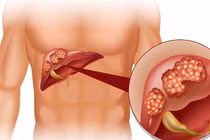 Ảnh hưởng của rối loạn chuyển hoá đến chức năng gan
