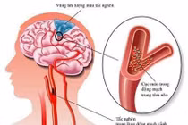 Cách chăm sóc, hỗ trợ người bệnh sau đột quỵ